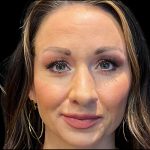 Sculptra Before & After Patient #11130