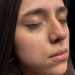 Lip Filler Before & After Patient #11224