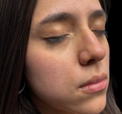 Lip Filler Before & After Patient #11224