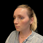 Rhinoplasty Before & After Patient #11186