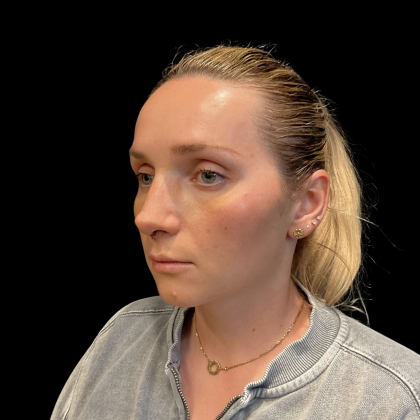 Rhinoplasty Before & After Patient #11186
