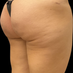 Alloclae Before & After Patient #11253