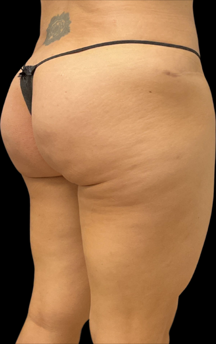 Alloclae Before & After Patient #11253