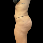 Brazilian Butt Lift Before & After Patient #11132