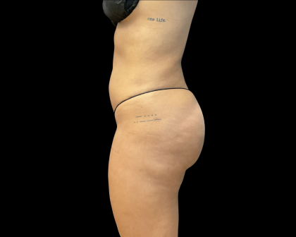 Brazilian Butt Lift Before & After Patient #11132