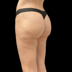 Auto Buttock Augmentation Before & After Patient #11188