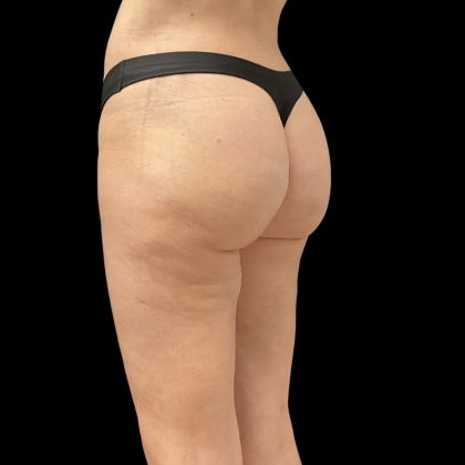 Auto Buttock Augmentation Before & After Patient #11188