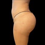 Brazilian Butt Lift Before & After Patient #11133