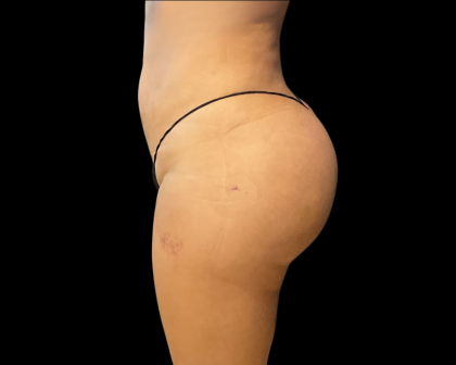 Brazilian Butt Lift Before & After Patient #11133