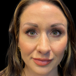 Sculptra Before & After Patient #11130