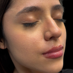Lip Filler Before & After Patient #11224