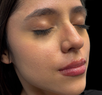 Lip Filler Before & After Patient #11224