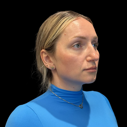 Rhinoplasty Before & After Patient #11186