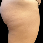 Alloclae Before & After Patient #11253