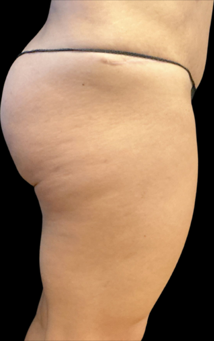 Alloclae Before & After Patient #11253