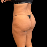 Brazilian Butt Lift Before & After Patient #11132