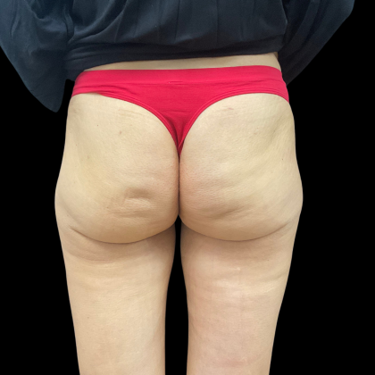 Auto Buttock Augmentation Before & After Patient #11188