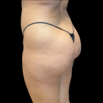 Brazilian Butt Lift Before & After Patient #11133