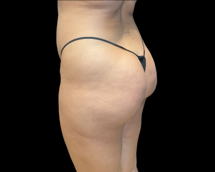 Brazilian Butt Lift Before & After Patient #11133
