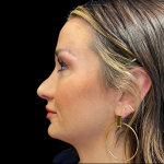 Sculptra Before & After Patient #11130