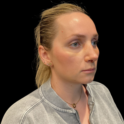 Rhinoplasty Before & After Patient #11186