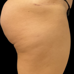 Alloclae Before & After Patient #11253