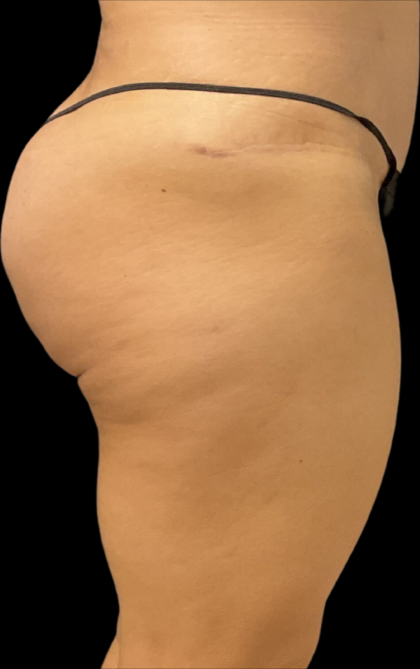 Alloclae Before & After Patient #11253