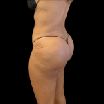 Brazilian Butt Lift Before & After Patient #11132