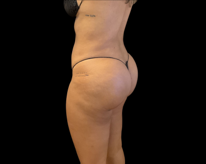 Brazilian Butt Lift Before & After Patient #11132