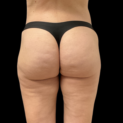 Auto Buttock Augmentation Before & After Patient #11188