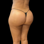 Brazilian Butt Lift Before & After Patient #11133