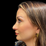 Sculptra Before & After Patient #11130