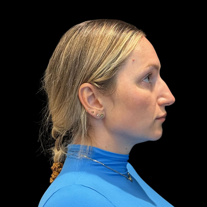 Rhinoplasty Before & After Patient #11186