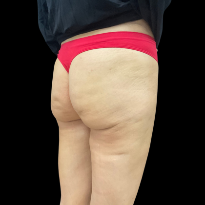 Auto Buttock Augmentation Before & After Patient #11188