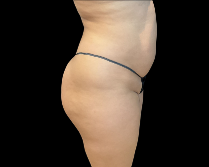Brazilian Butt Lift Before & After Patient #11133