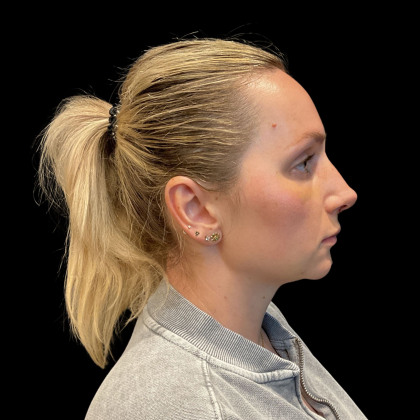 Rhinoplasty Before & After Patient #11186