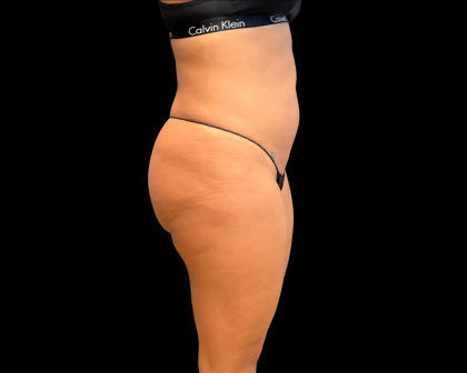 Brazilian Butt Lift Before & After Patient #11132