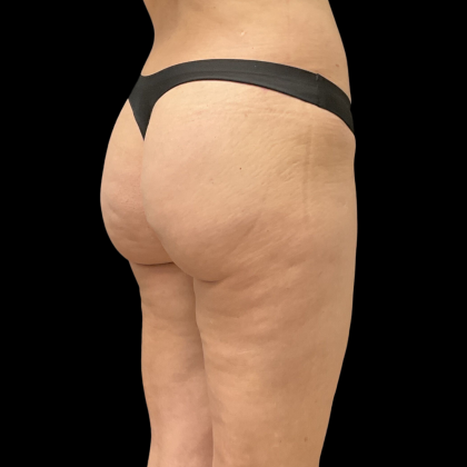 Auto Buttock Augmentation Before & After Patient #11188