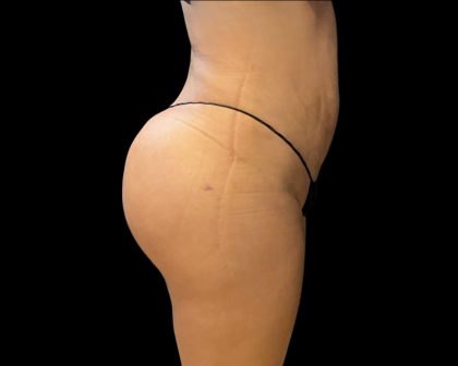 Brazilian Butt Lift Before & After Patient #11133