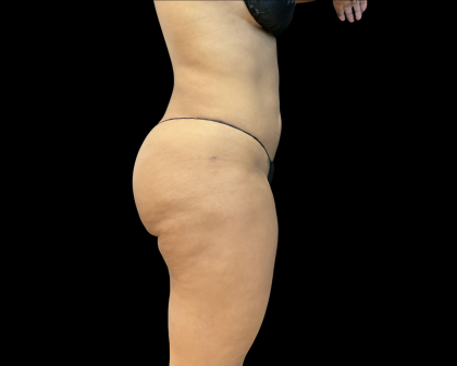 Brazilian Butt Lift Before & After Patient #11132