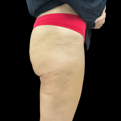 Auto Buttock Augmentation Before & After Patient #11188