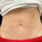 Sculptra Before & After Patient #11131