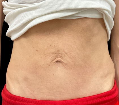 Sculptra Before & After Patient #11131