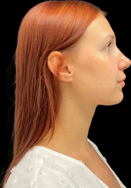Rhinoplasty Before & After Patient #11378