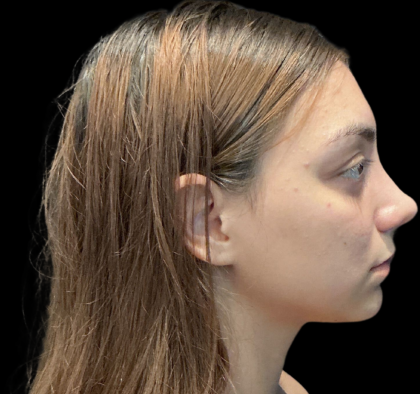 Rhinoplasty Before & After Patient #11380