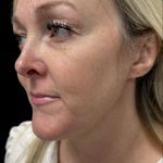 AVAVA Laser Before & After Patient #11381
