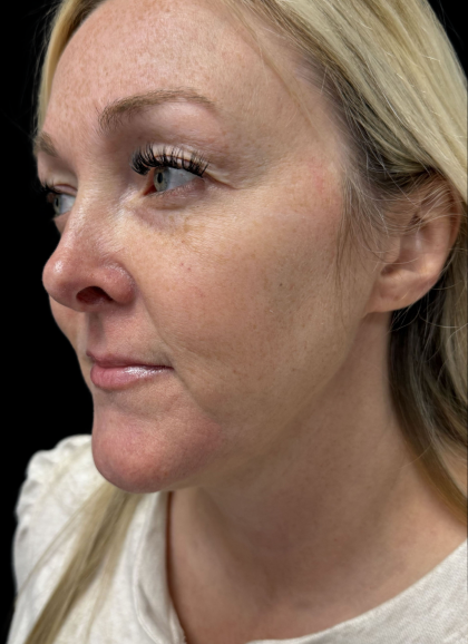 AVAVA Laser Before & After Patient #11381