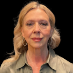 Blepharoplasty Before & After Patient #11377