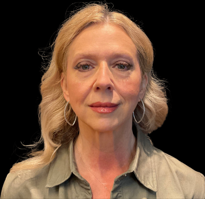 Blepharoplasty Before & After Patient #11377