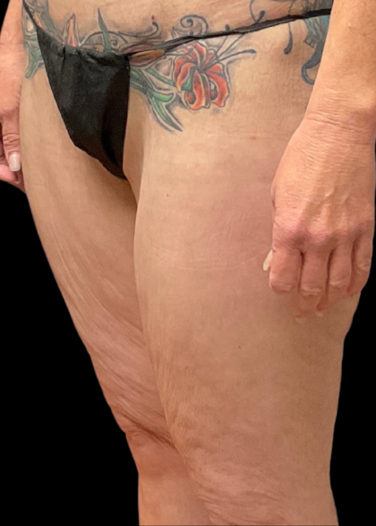 Thigh Lift Before & After Patient #11382
